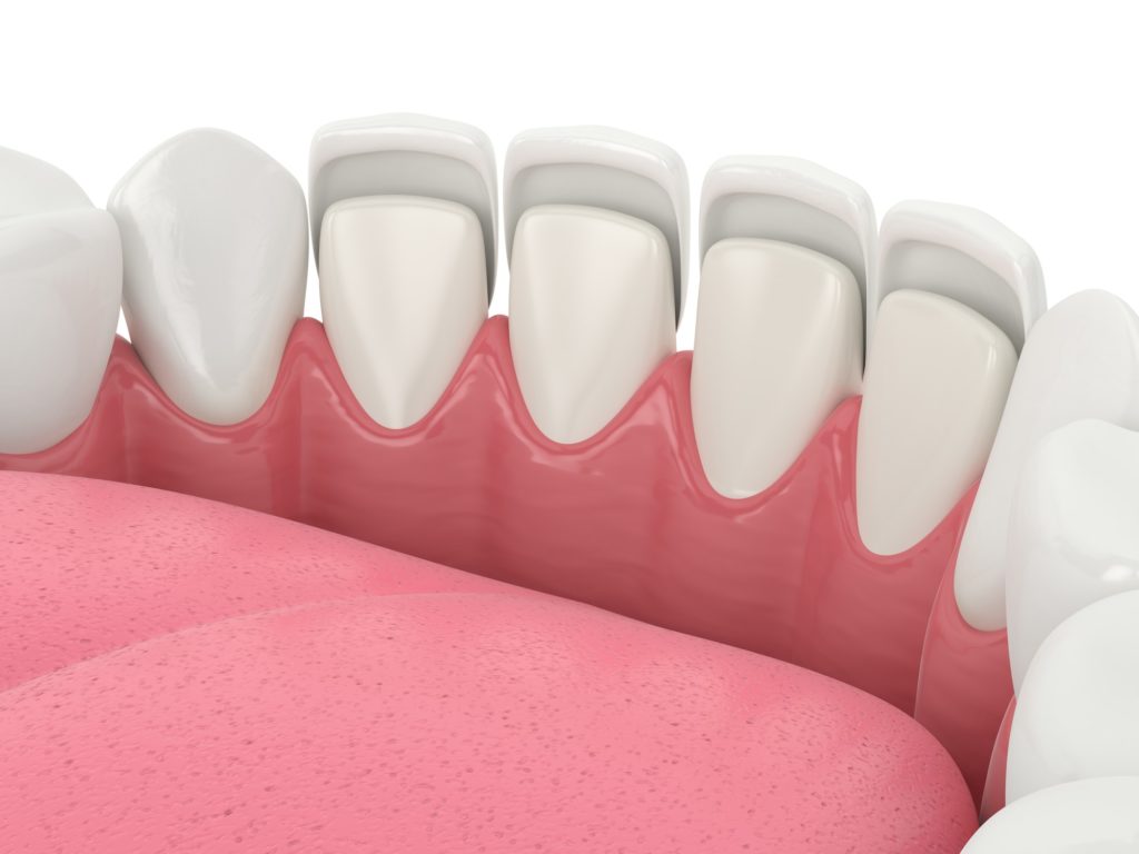 Illustration of a bottom row of teeth with veneers being applied