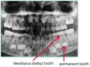 Dental x-ray showing permanent teeth coming in below baby teeth