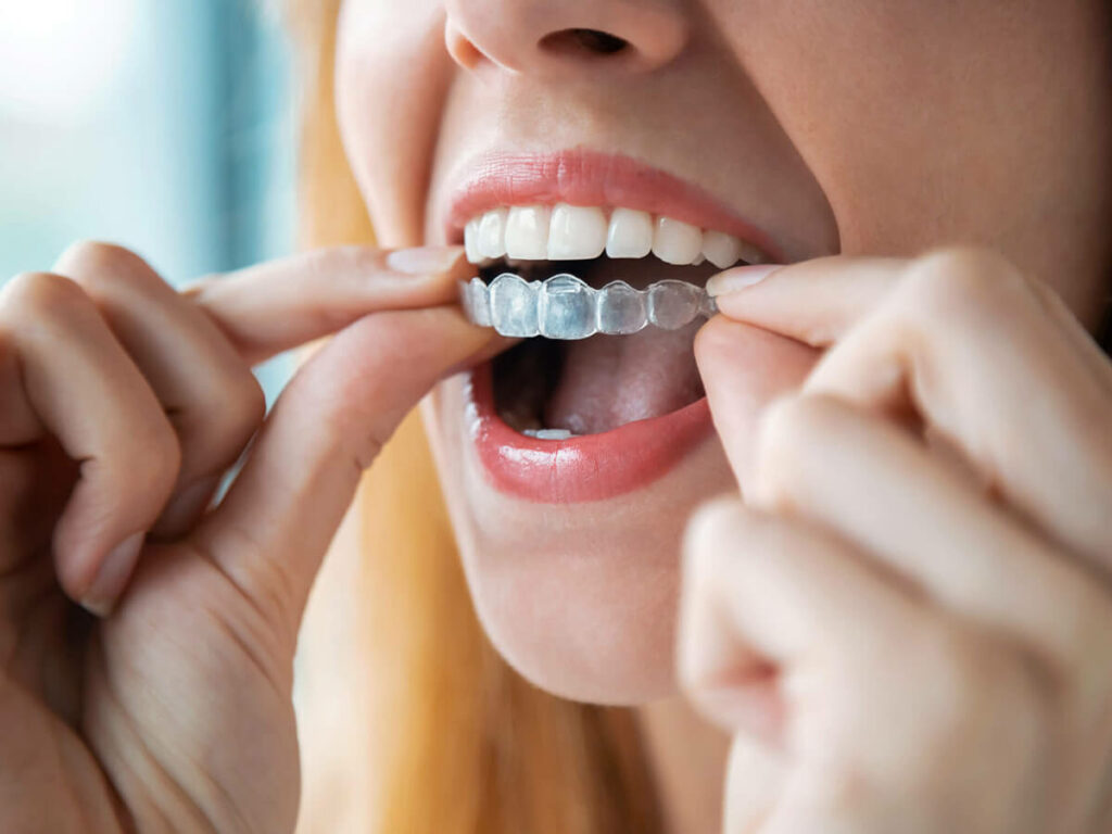 Invisalign clear aligners being placed on the top row of teeth
