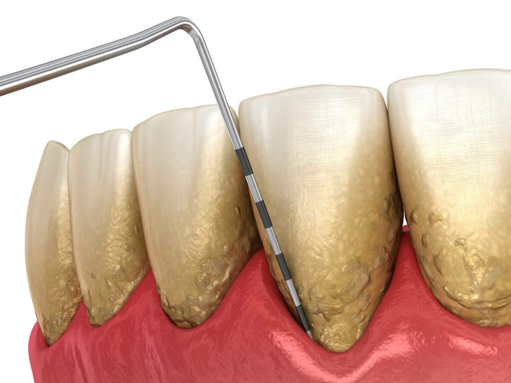 illustration of dental probe testing for gum disease