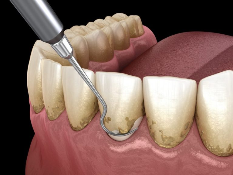 Illustration of a dental pick scraping plaque off a bottom row of teeth