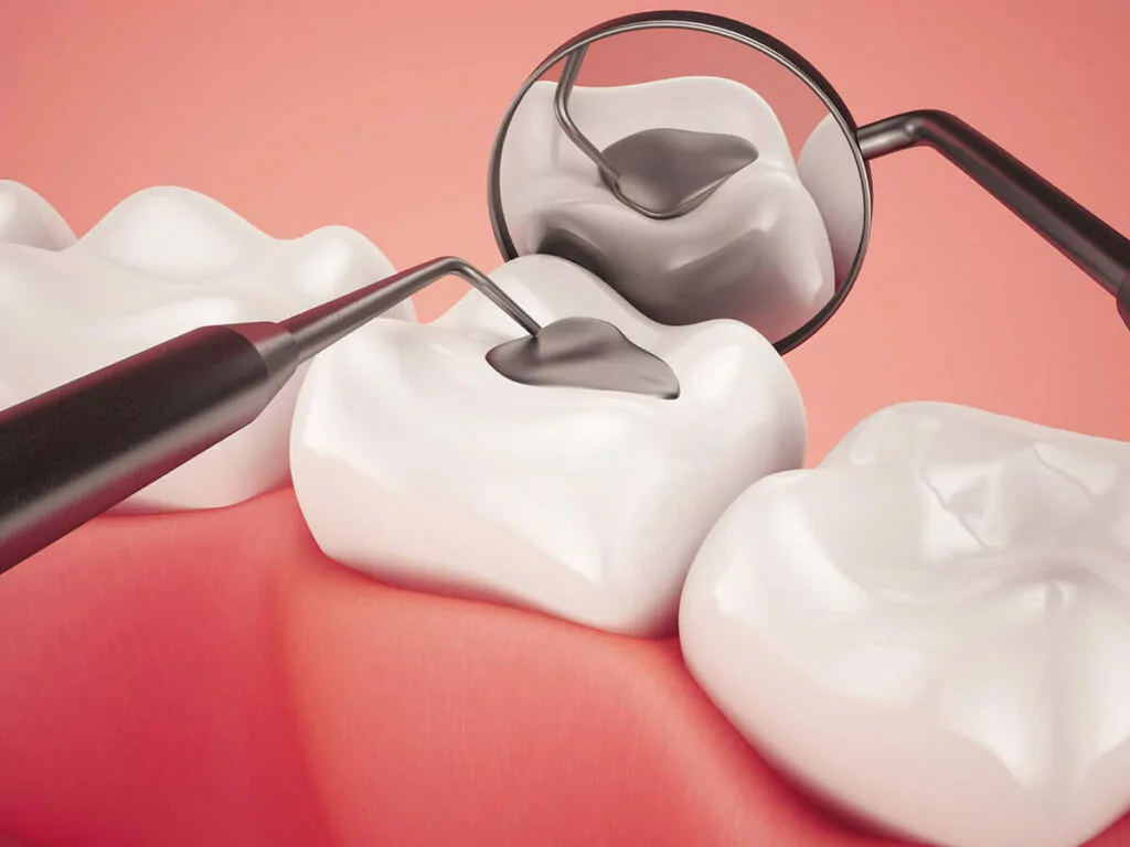 tooth filling illustration