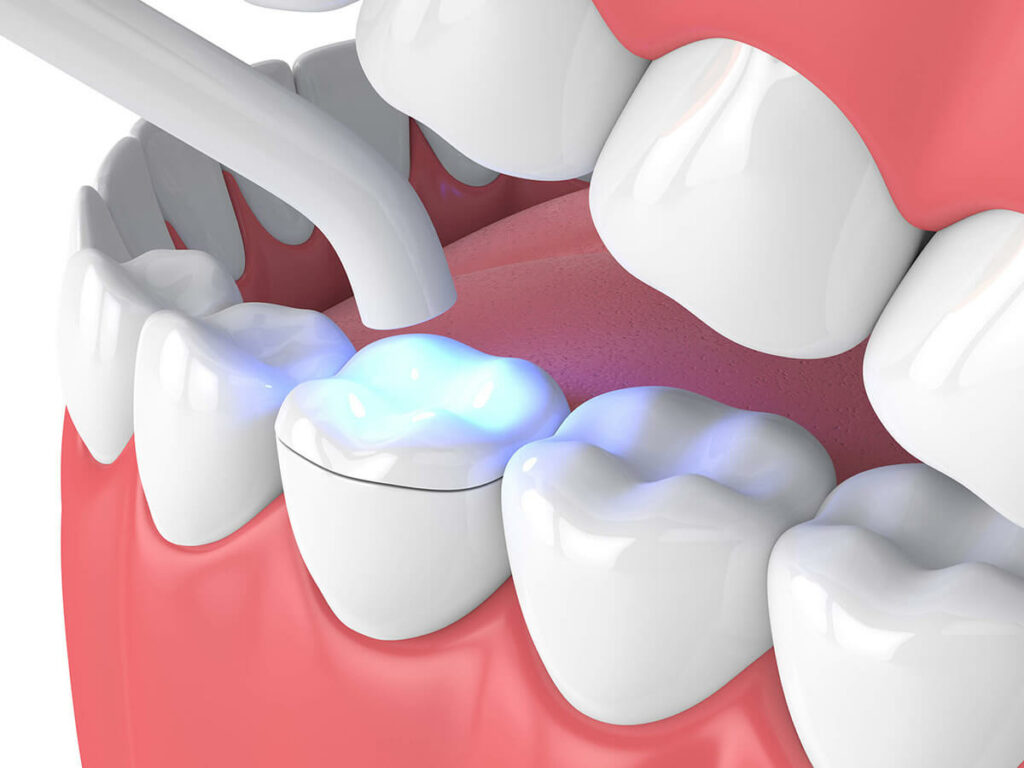 dental inlay illustration