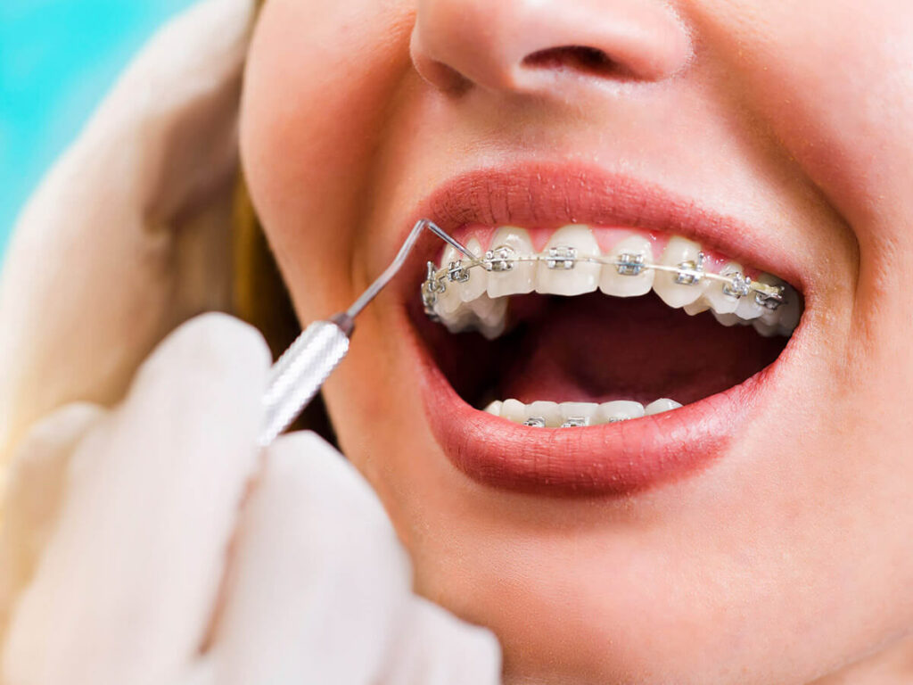 metal dental braces