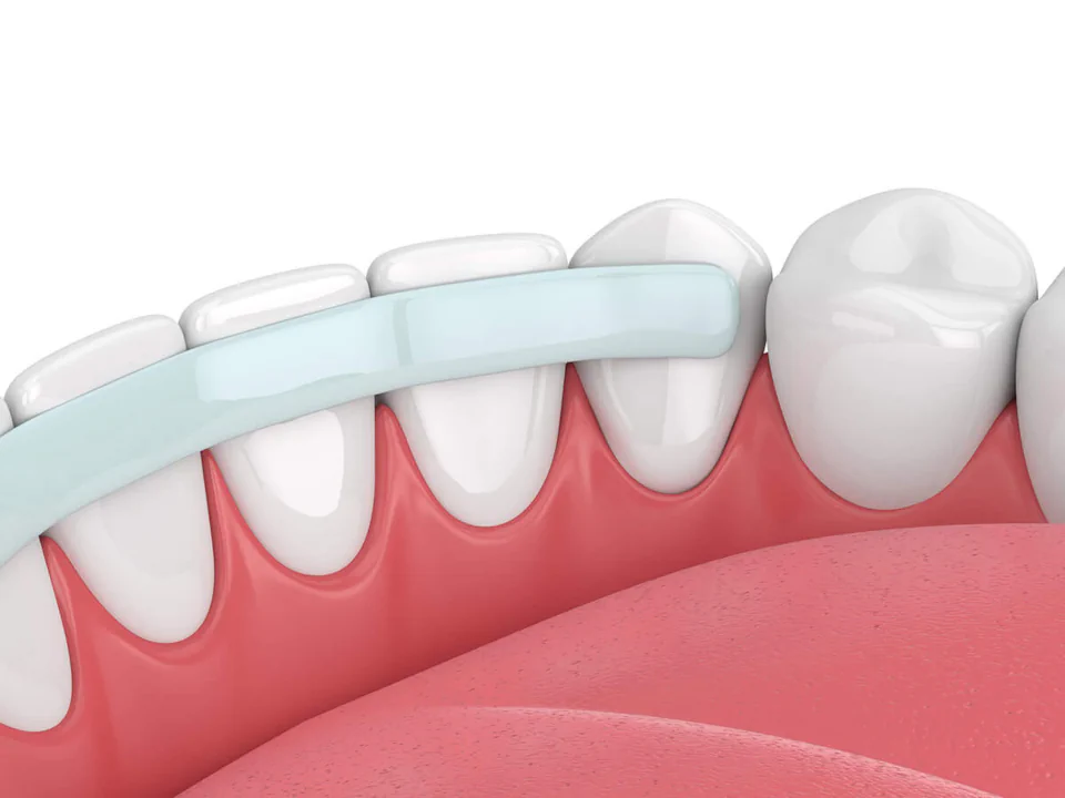Dental Bonding in Maynard, MA at Maynard Family Dentists
