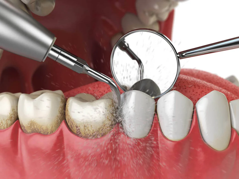 Dental Checkups in Maynard, MA at Maynard Family Dentists