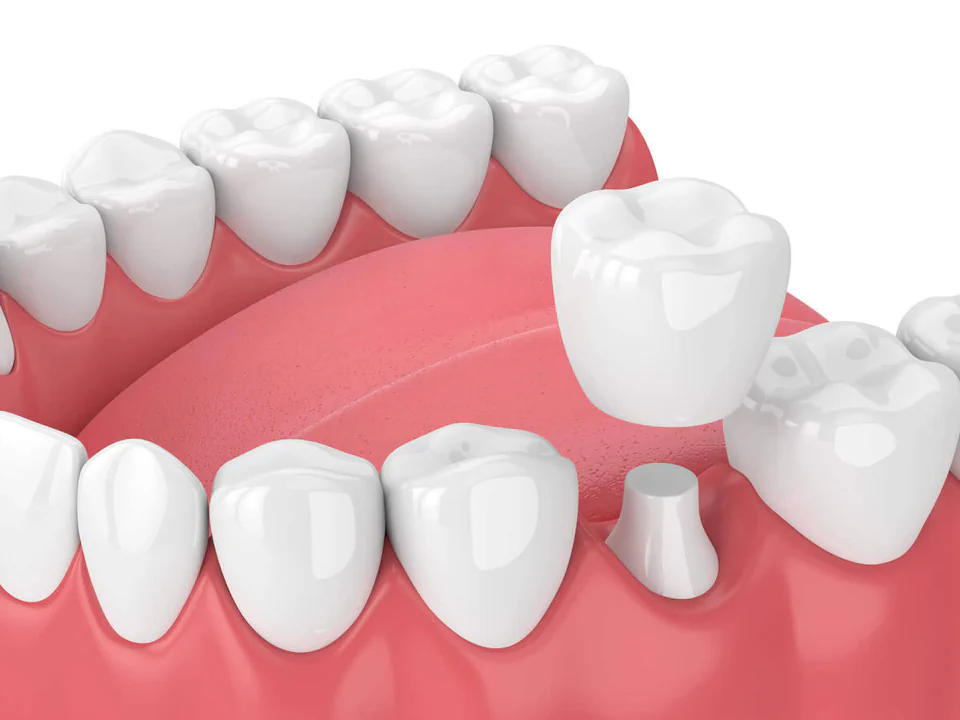 Dental Crowns in Maynard, MA at Maynard Family Dentists