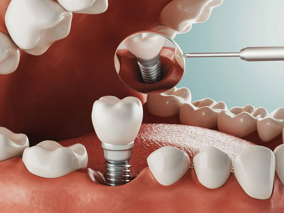 Dental Implants in Maynard, MA at Maynard Family Dentists