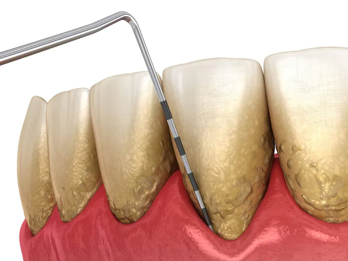 Gum Disease Treatment in Maynard, MA at Maynard Family Dentists