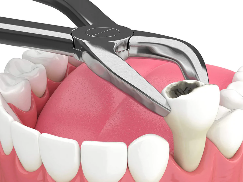 Tooth Extractions in Maynard, MA at Maynard Family Dentists